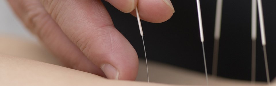 mvacupuncture